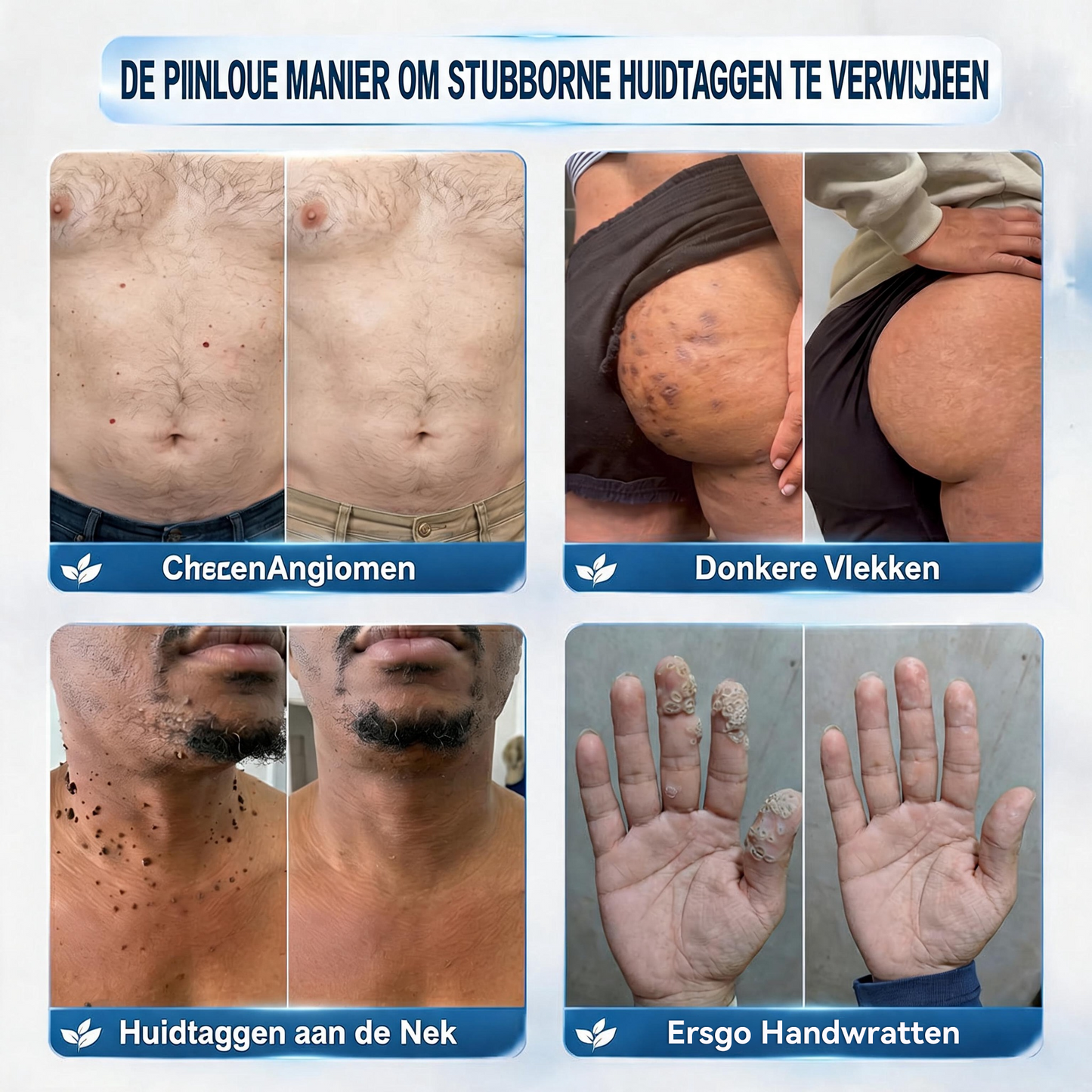 Natravor® Geavanceerde Corrigerende Crème voor Huidflapjes, Moedervlekken & Vlekken – 7 Dagen Zonder Pijn & Zonder Littekens – Geavanceerde Verzorging voor Huidoneffenheden