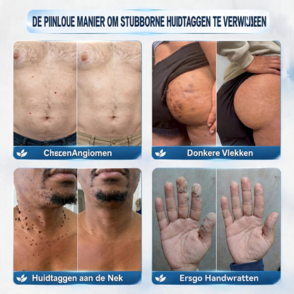 Natravor® Geavanceerde Corrigerende Crème voor Huidflapjes, Moedervlekken & Vlekken – 7 Dagen Zonder Pijn & Zonder Littekens – Geavanceerde Verzorging voor Huidoneffenheden