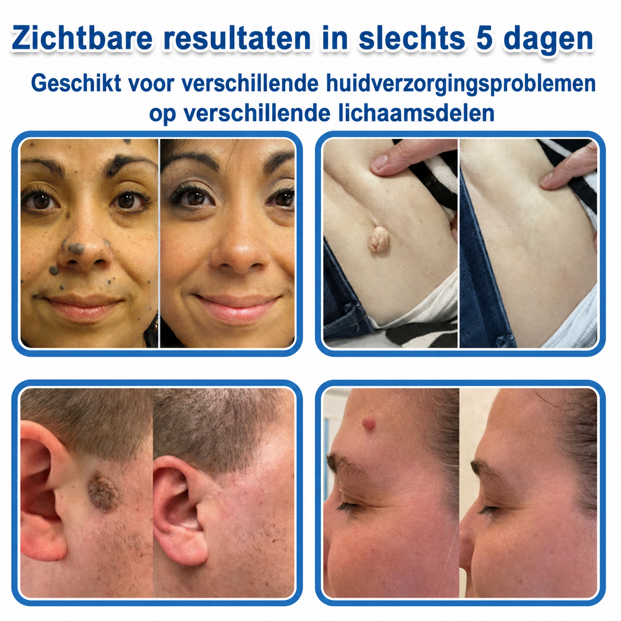 ✨TopSpire® 2-in-1 Microneedle & Hydrocolloid Patch | Targeted Solution for Raised Moles, Acne, Flat Warts & Skin Tags | Helps Improve the Appearance of Fine Lines, Scars & Skin Imperfections | Invisible Star Pimple Patches for Face & Body