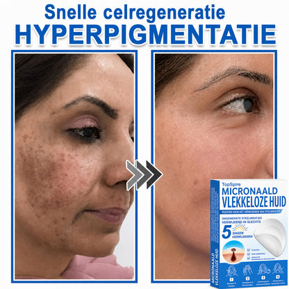 ✨TopSpire® 2-in-1 Microneedle & Hydrocolloid Patch | Targeted Solution for Raised Moles, Acne, Flat Warts & Skin Tags | Helps Improve the Appearance of Fine Lines, Scars & Skin Imperfections | Invisible Star Pimple Patches for Face & Body
