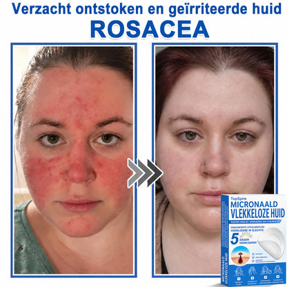 ✨TopSpire® 2-in-1 Microneedle & Hydrocolloid Patch | Targeted Solution for Raised Moles, Acne, Flat Warts & Skin Tags | Helps Improve the Appearance of Fine Lines, Scars & Skin Imperfections | Invisible Star Pimple Patches for Face & Body