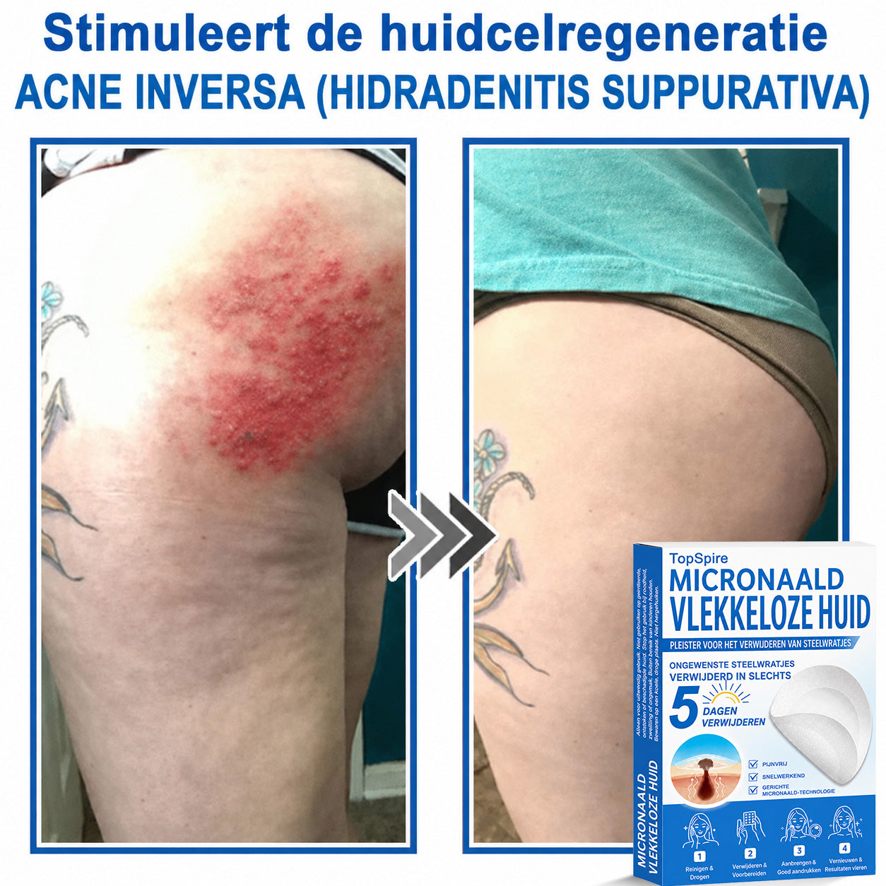 ✨TopSpire® 2-in-1 Microneedle & Hydrocolloid Patch | Targeted Solution for Raised Moles, Acne, Flat Warts & Skin Tags | Helps Improve the Appearance of Fine Lines, Scars & Skin Imperfections | Invisible Star Pimple Patches for Face & Body