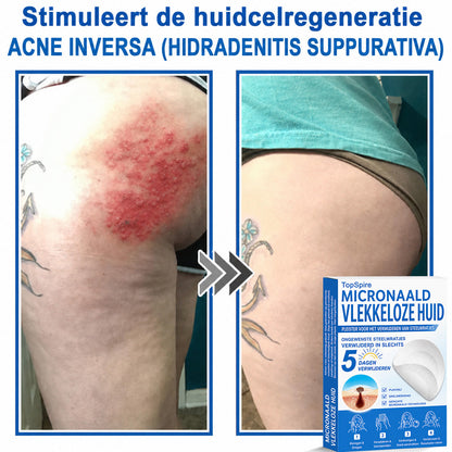 ✨TopSpire® 2-in-1 Microneedle & Hydrocolloid Patch | Targeted Solution for Raised Moles, Acne, Flat Warts & Skin Tags | Helps Improve the Appearance of Fine Lines, Scars & Skin Imperfections | Invisible Star Pimple Patches for Face & Body