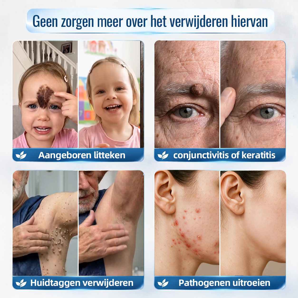 Natravor® Geavanceerde Corrigerende Crème voor Huidflapjes, Moedervlekken & Vlekken – 7 Dagen Zonder Pijn & Zonder Littekens – Geavanceerde Verzorging voor Huidoneffenheden